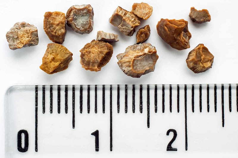 Kidney stones next to a ruler